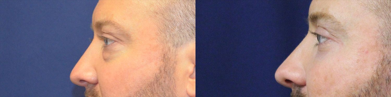 Blepharoplasty Before & After