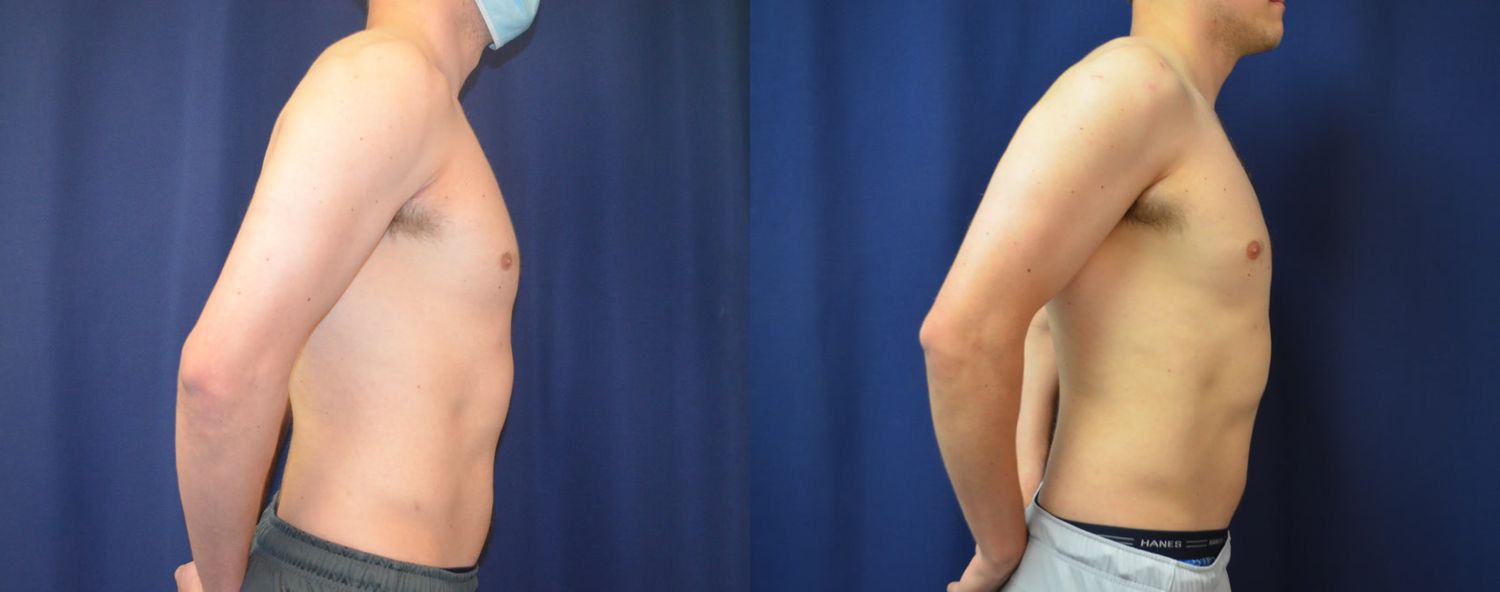 Gynecomastia Before & After