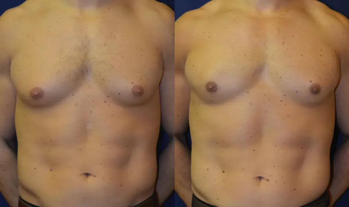 Gynecomastia Before & After