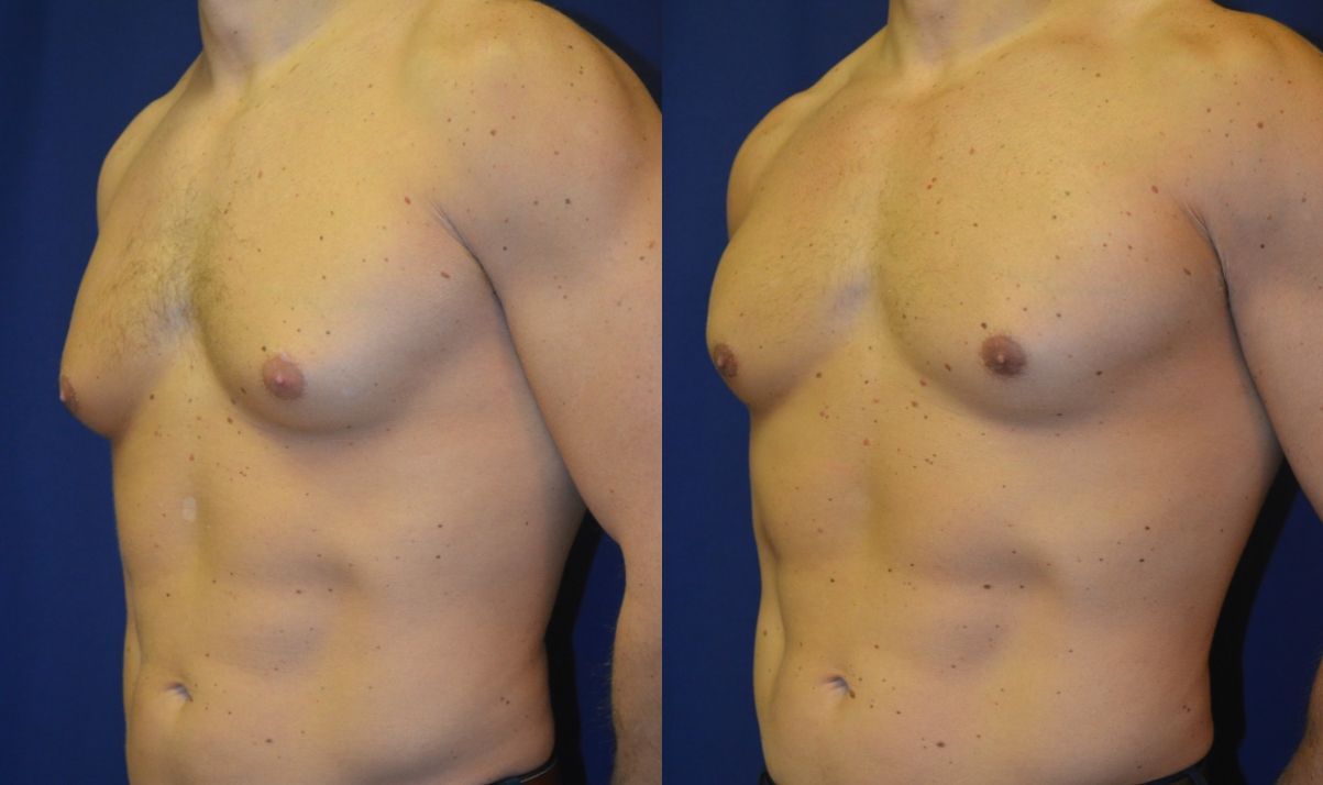 Gynecomastia Before & After