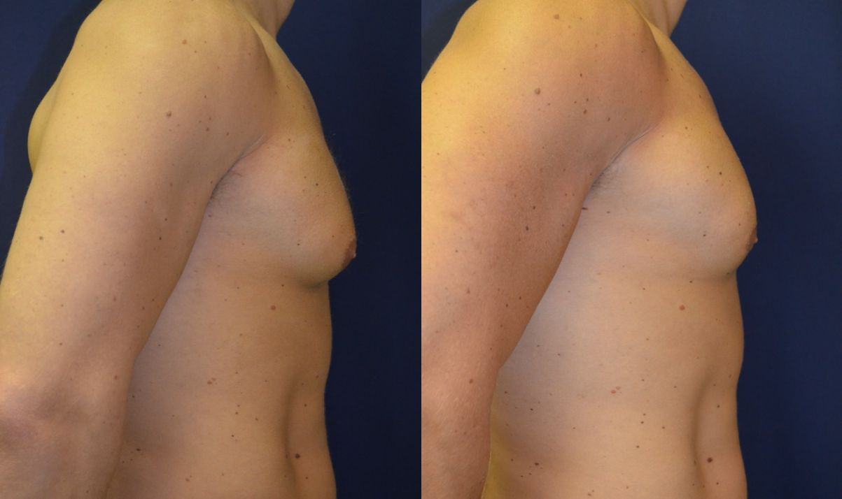 Gynecomastia Before & After