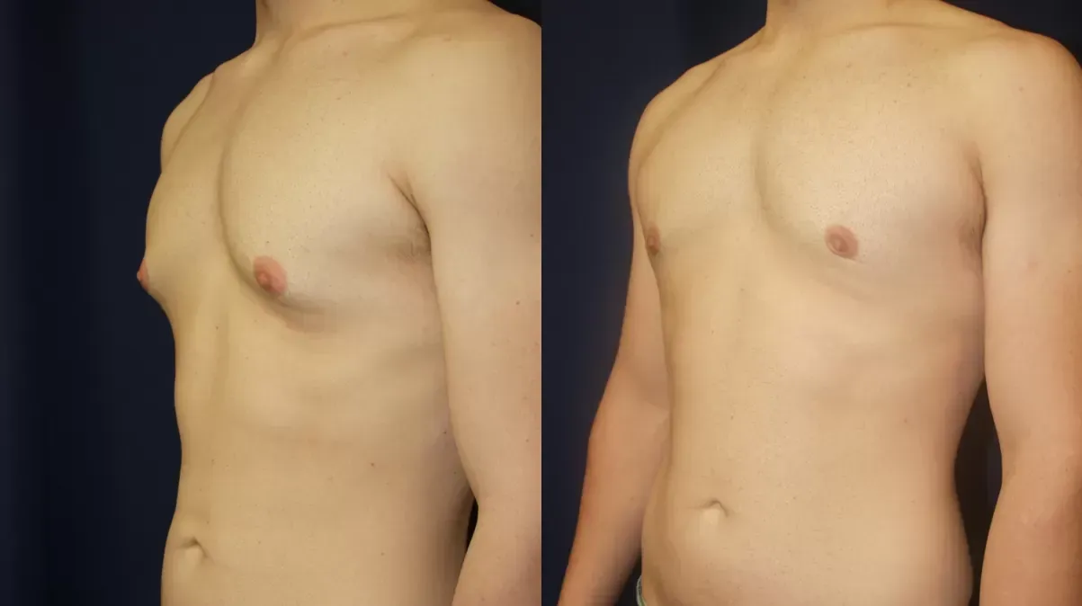 Gynecomastia Before & After