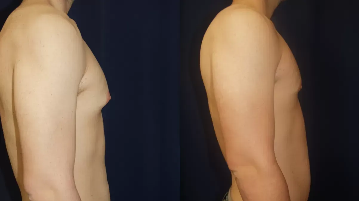 Gynecomastia Before & After