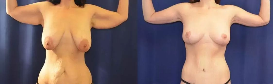 Brachioplasty Before & After