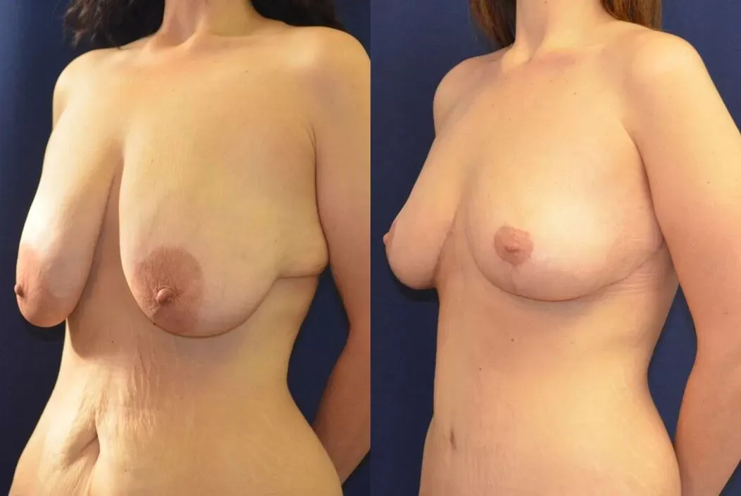 Brachioplasty Before & After