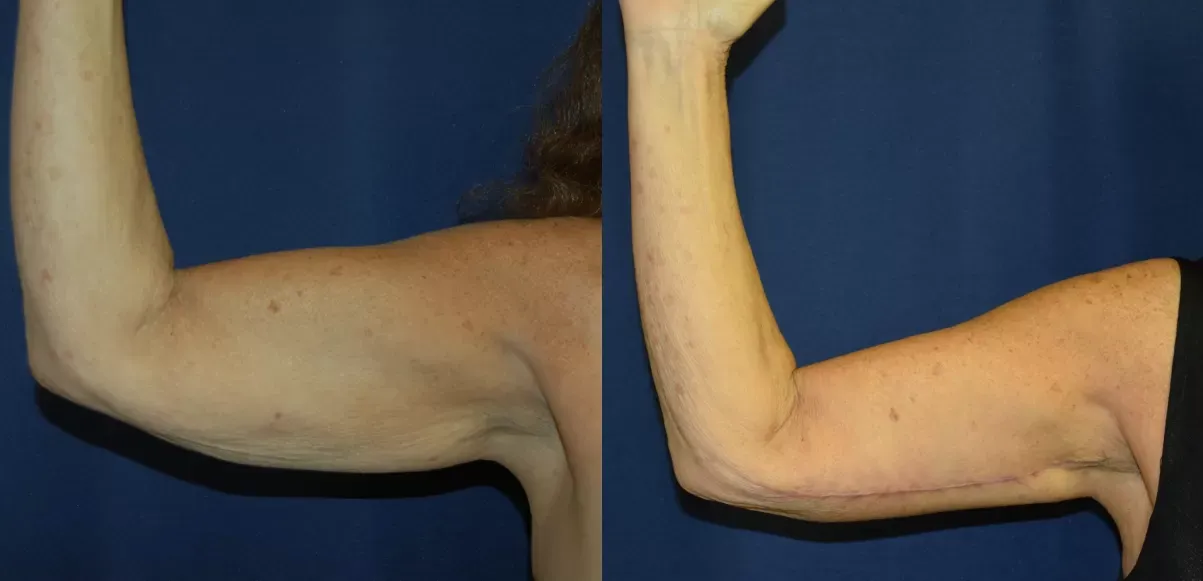 Brachioplasty Before & After