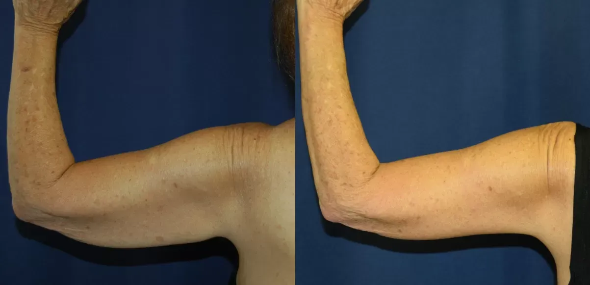 Brachioplasty Before & After