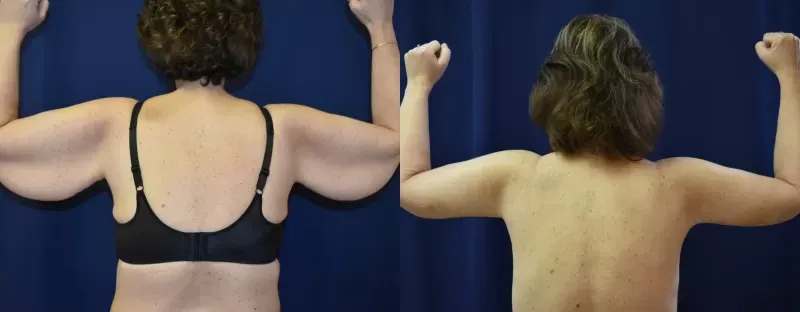 Brachioplasty Before & After