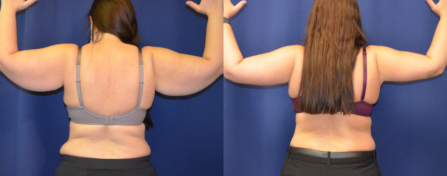 Brachioplasty Before & After