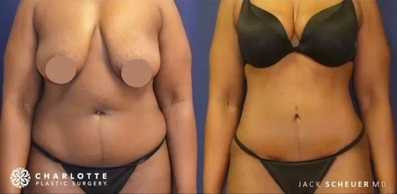 Mommy Makeover Before & After