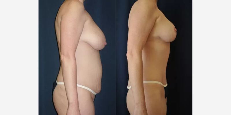 Mommy Makeover Before & After