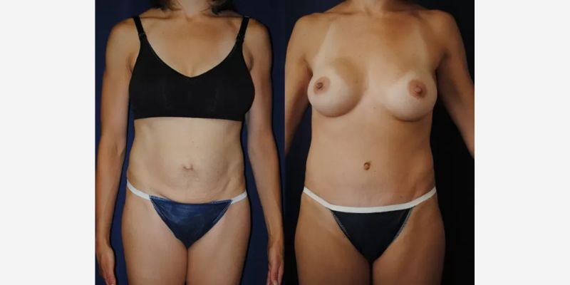 Mommy Makeover Before & After