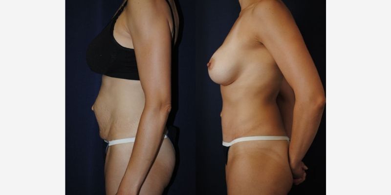 Mommy Makeover Before & After