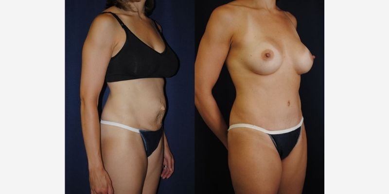 Mommy Makeover Before & After