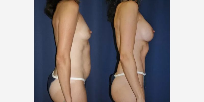 Mommy Makeover Before & After