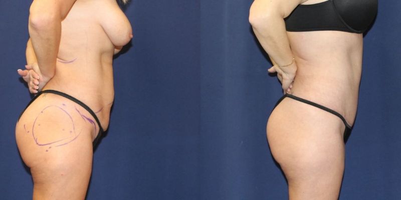 Mommy Makeover Before & After