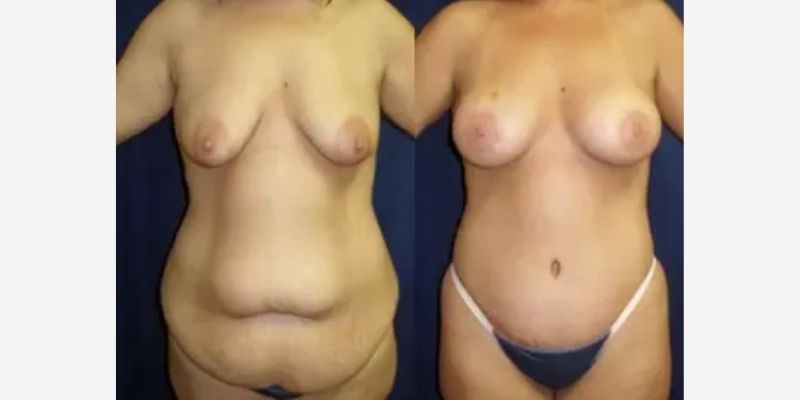 Mommy Makeover Before & After