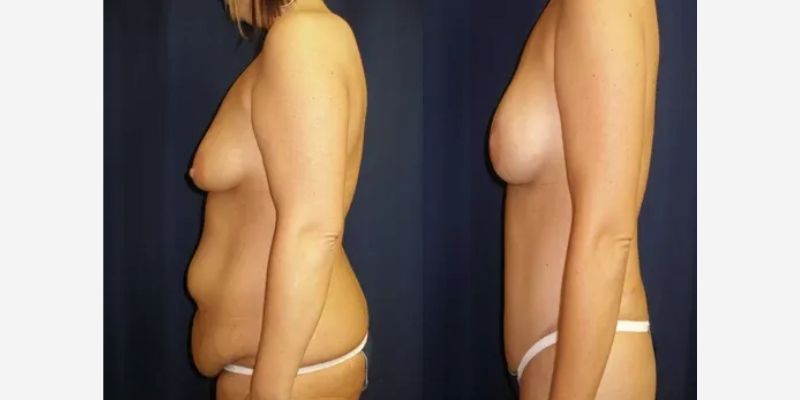 Mommy Makeover Before & After