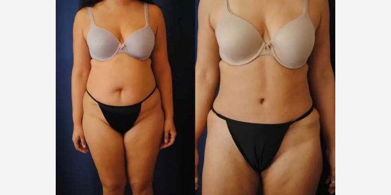 Mommy Makeover Before & After