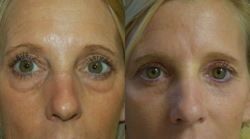 Blepharoplasty Before & After