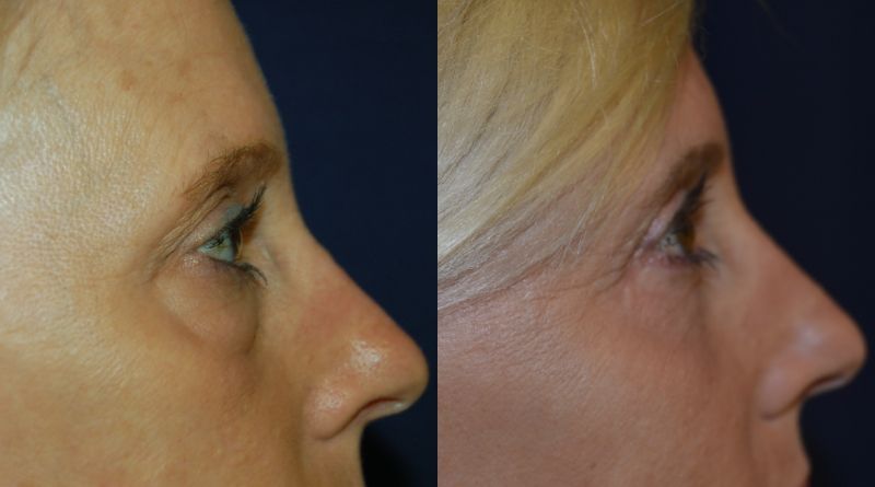 Blepharoplasty Before & After