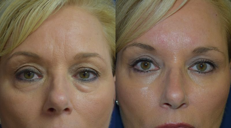Blepharoplasty Before & After