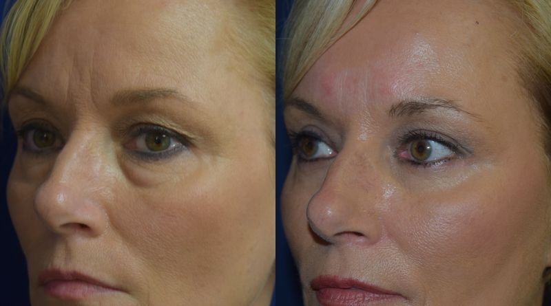 Blepharoplasty Before & After