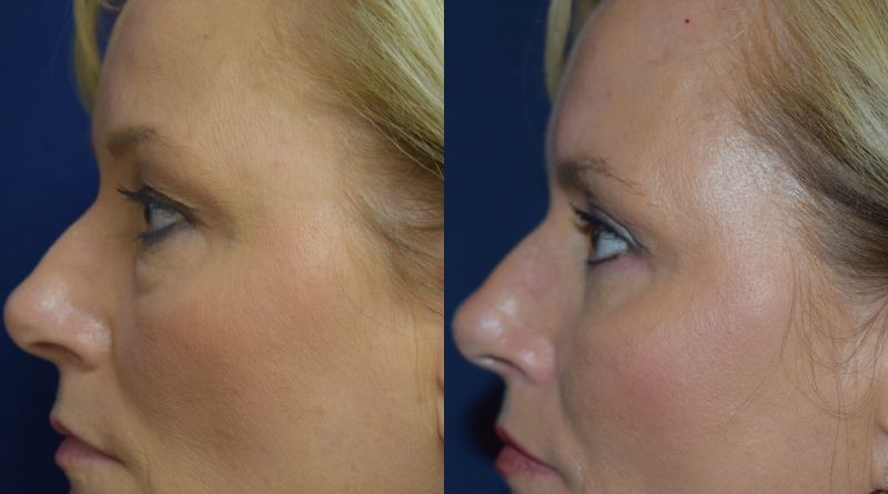 Blepharoplasty Before & After