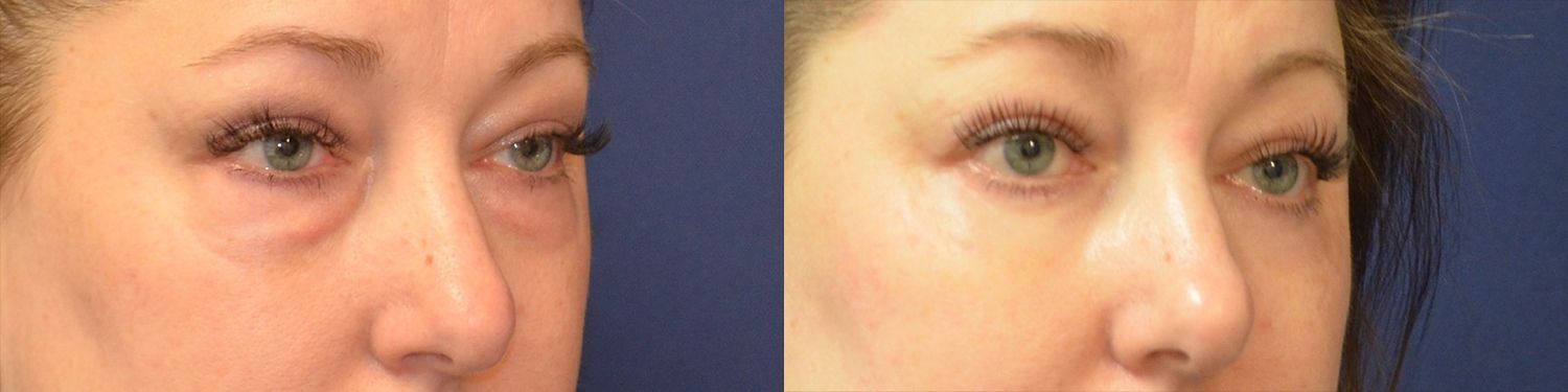Blepharoplasty Before & After