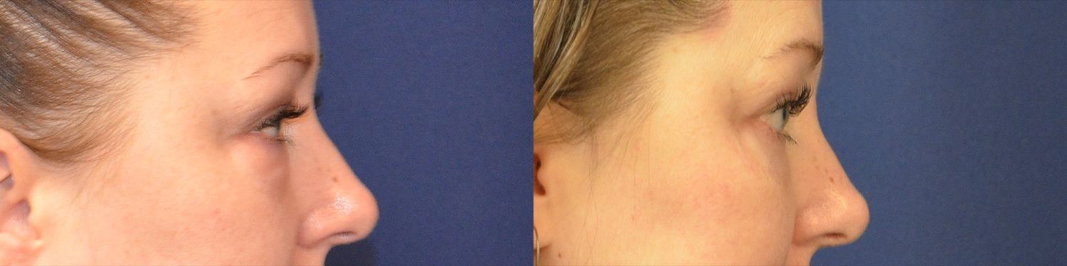 Blepharoplasty Before & After