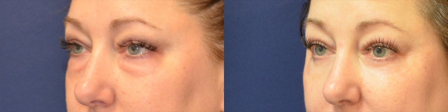 Blepharoplasty Before & After