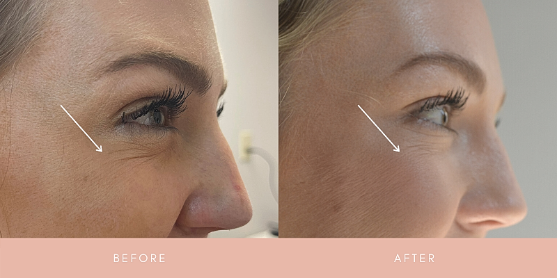 Botox Before & After