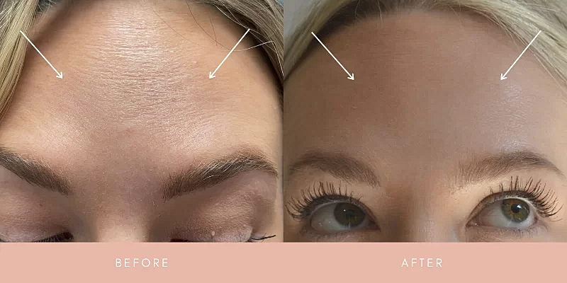 Botox Before & After