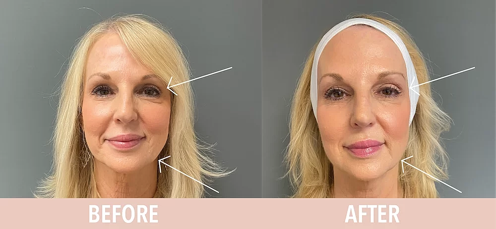 Botox Before & After