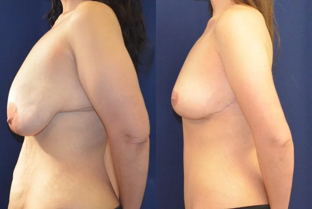 Breast Lift Before & After
