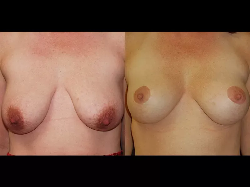 Breast Lift Before & After