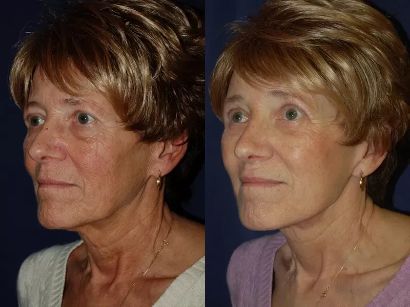 Forehead Lift Before & After