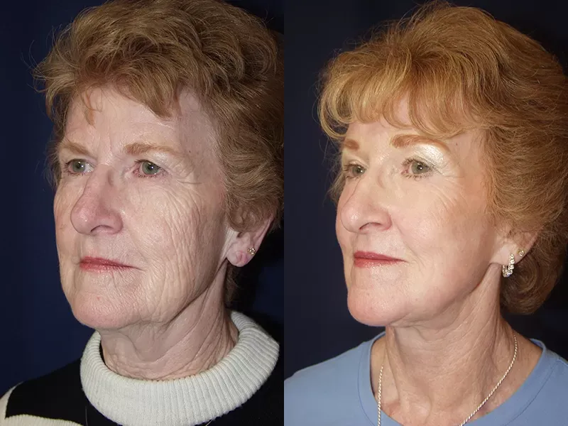 Forehead Lift Before & After