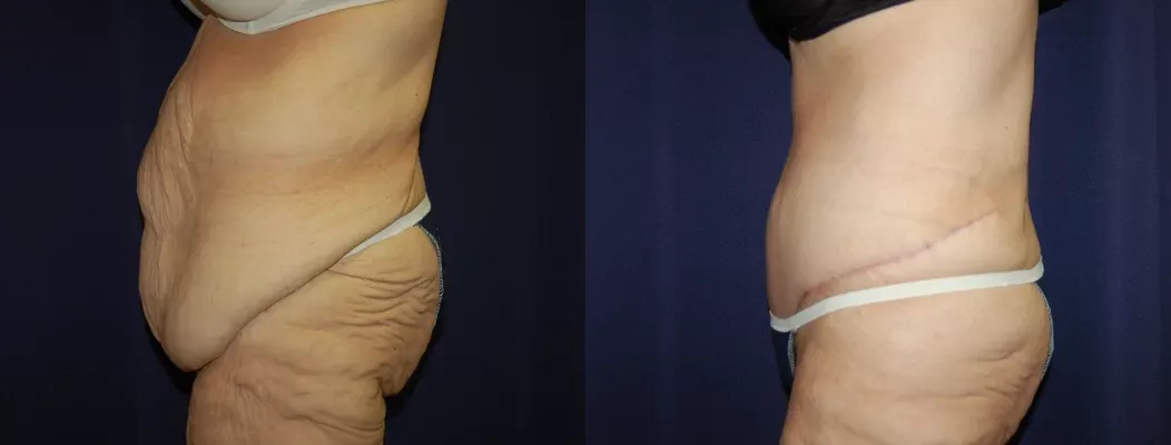 Body Contouring Before & After