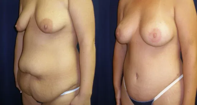 Body Contouring Before & After