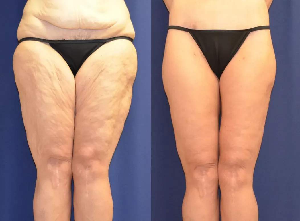 Body Contouring Before & After