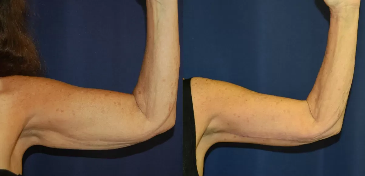 Body Contouring Before & After