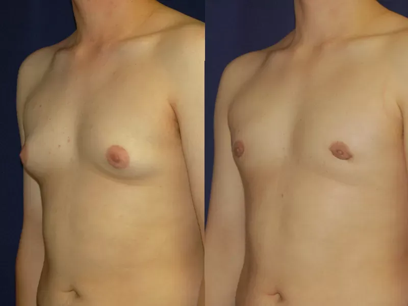 Body Contouring Before & After