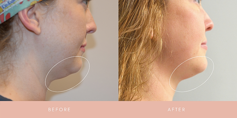 Kybella Before & After