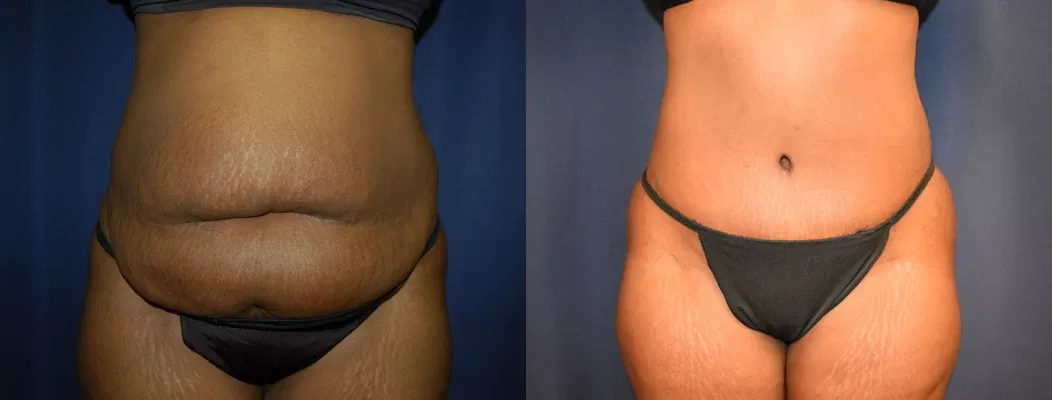 Tummy Tuck Before & After