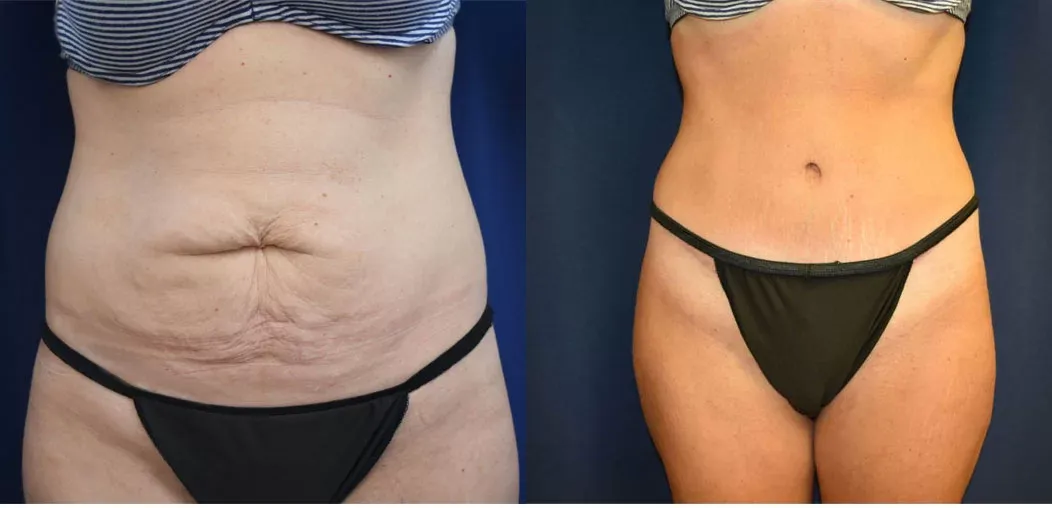 Tummy Tuck Before & After
