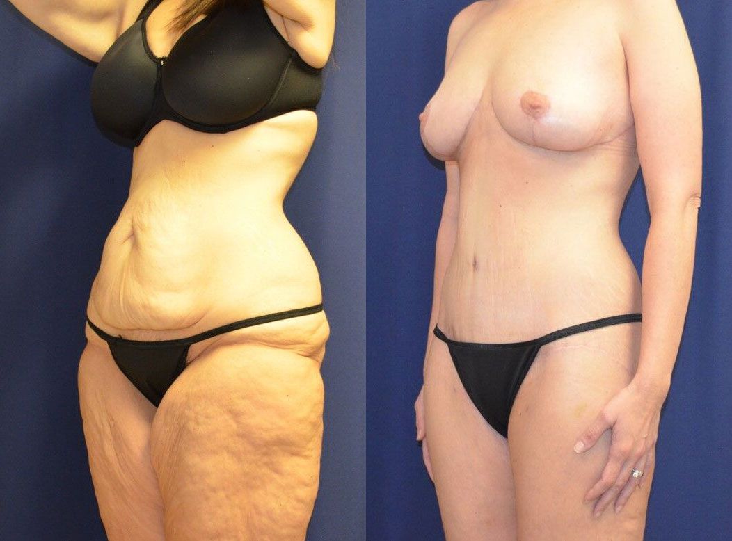 Tummy Tuck Before & After