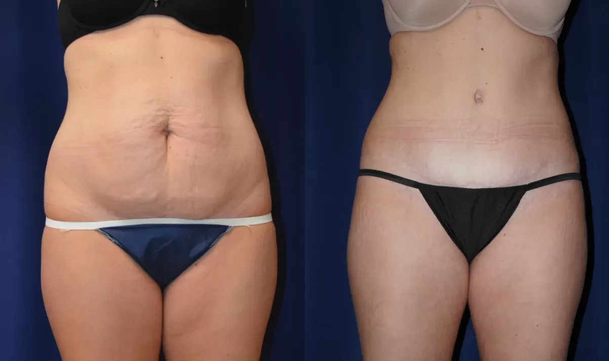 Tummy Tuck Before & After