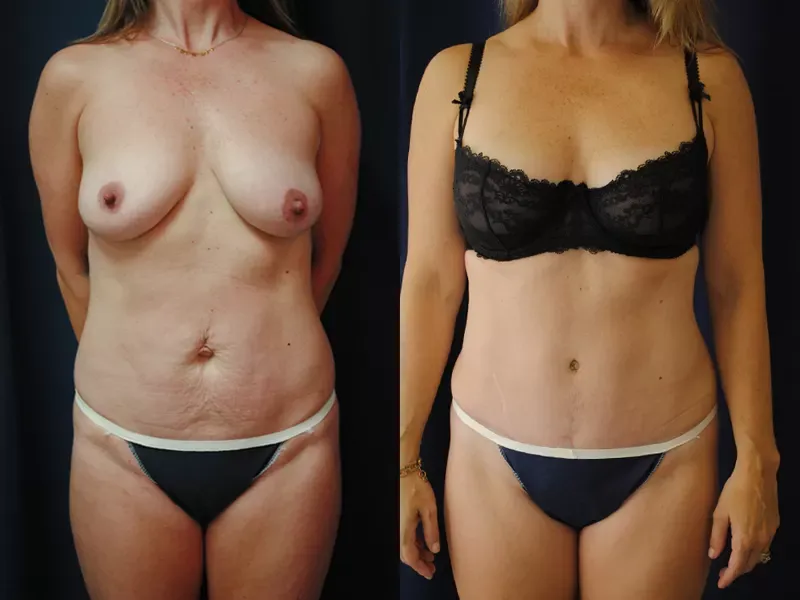 Tummy Tuck Before & After