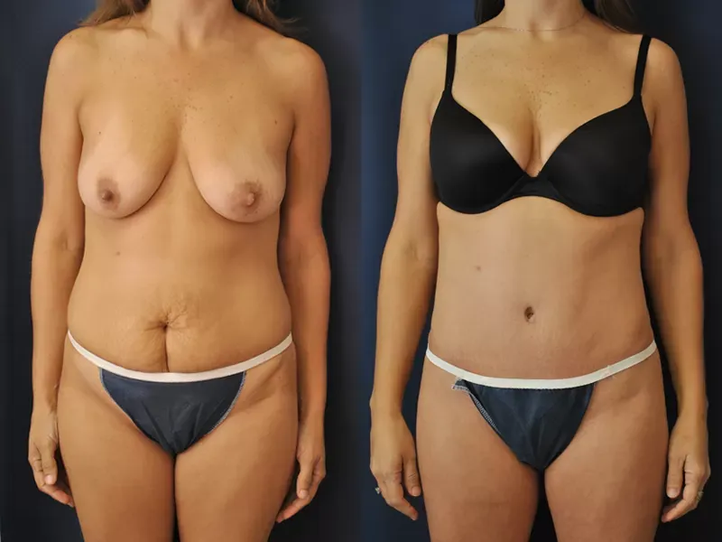 Tummy Tuck Before & After